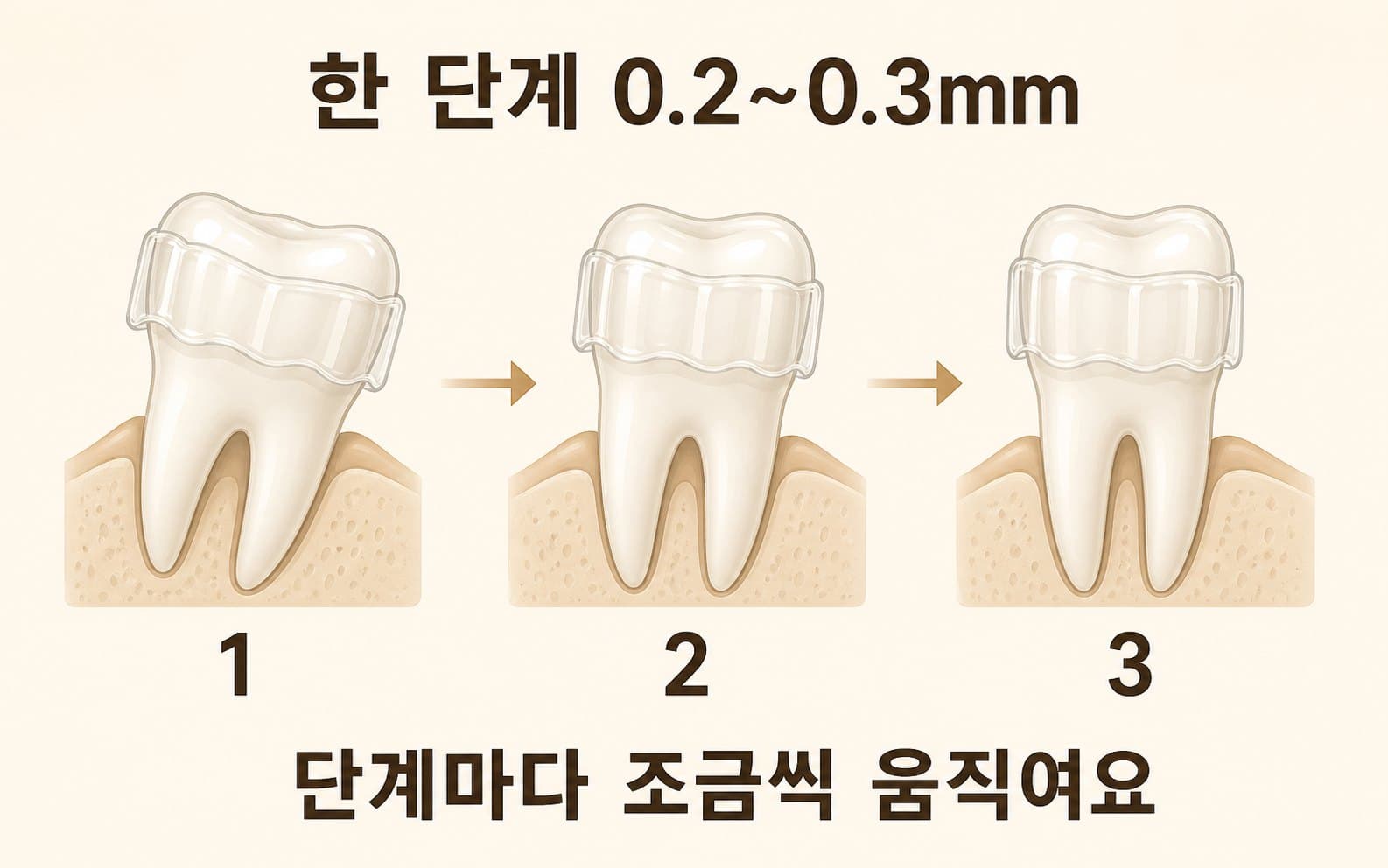 인포그래픽 — 투명교정 단계별 이동 원리
