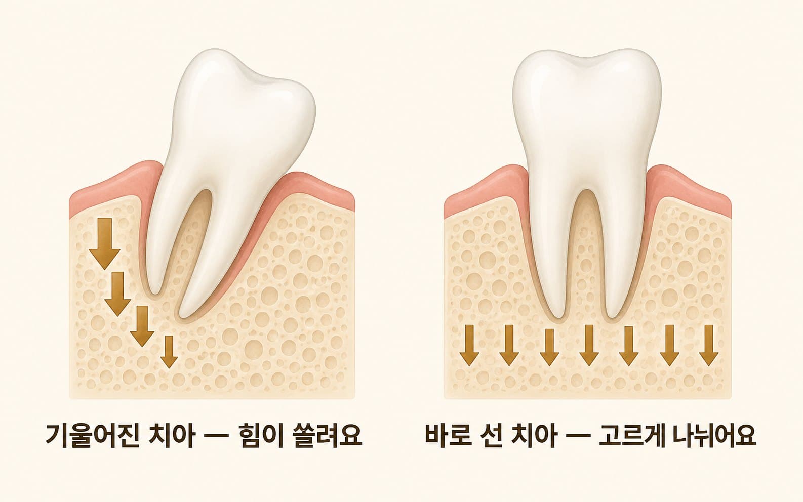 인포그래픽 — 기울어진 치아 vs 바로 선 치아 — 잇몸뼈에 실리는 힘 비교
