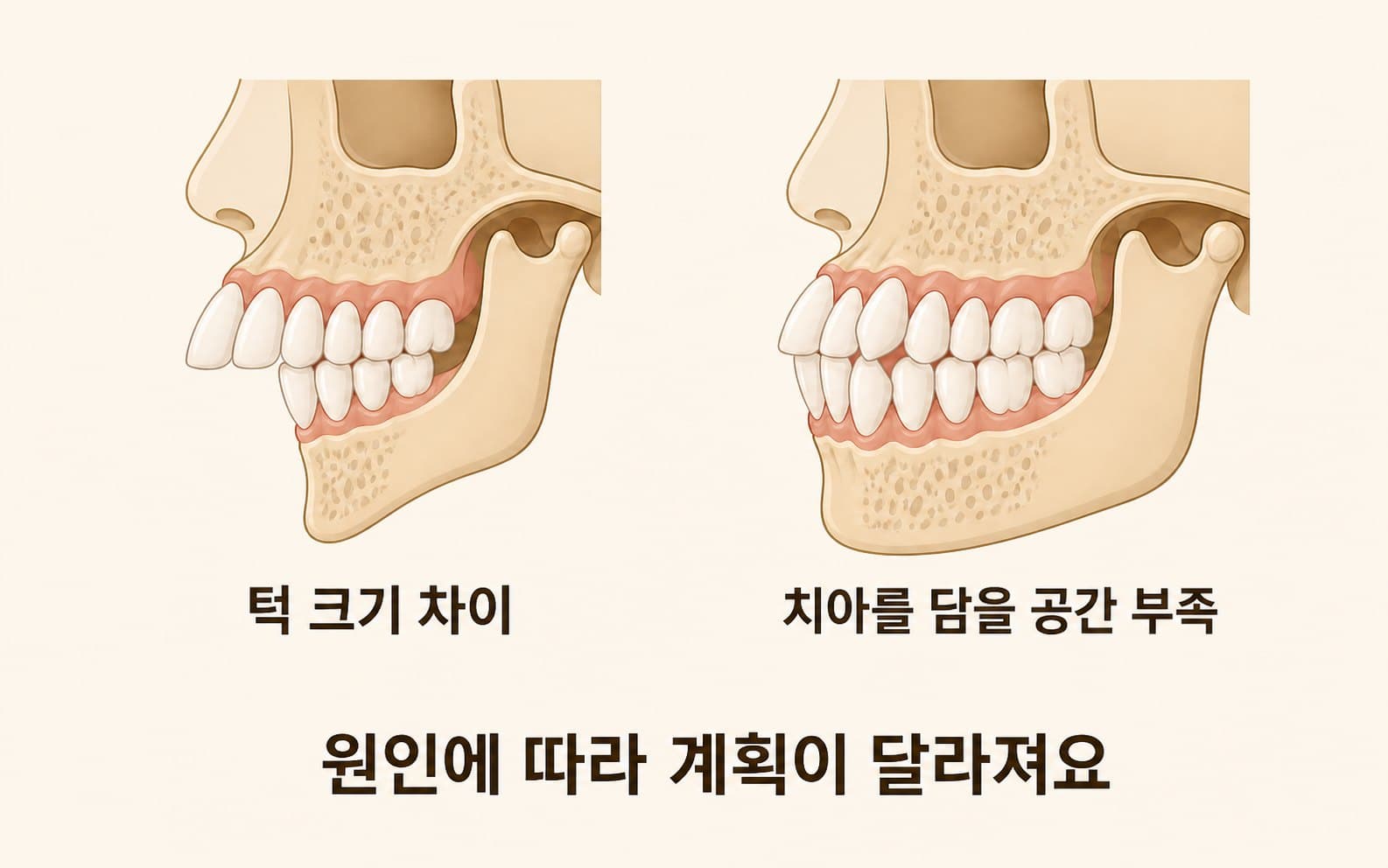 인포그래픽 — 돌출입 원인 두 유형 — 턱 크기 차이 vs 치아·턱 공간 부조화