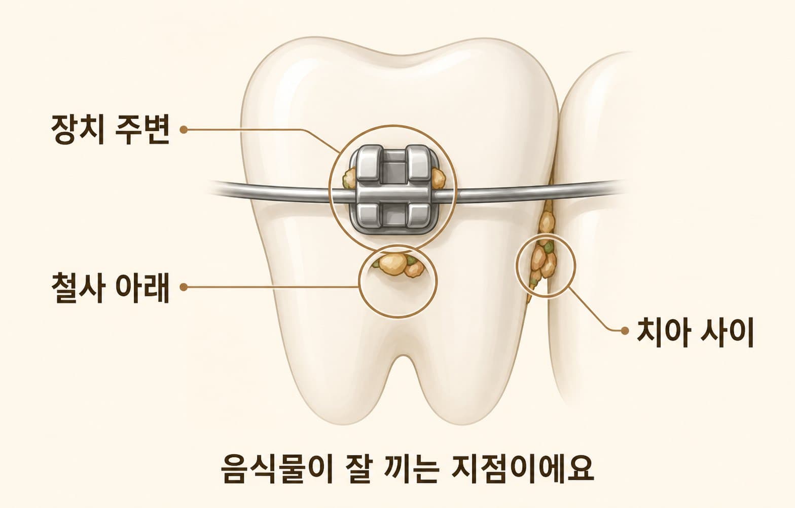 인포그래픽 — 치아+브라켓 도해 — 음식물이 잘 끼는 지점(장치 주변·철사 아래·치아 사이)