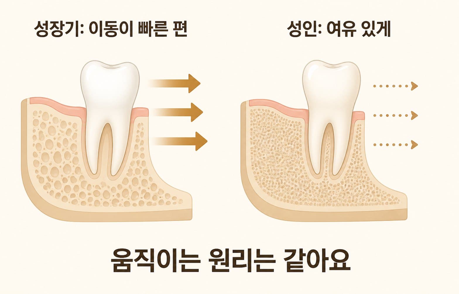 인포그래픽 — 성장기 vs 성인 교정 — 치아 이동 속도와 계획의 차이