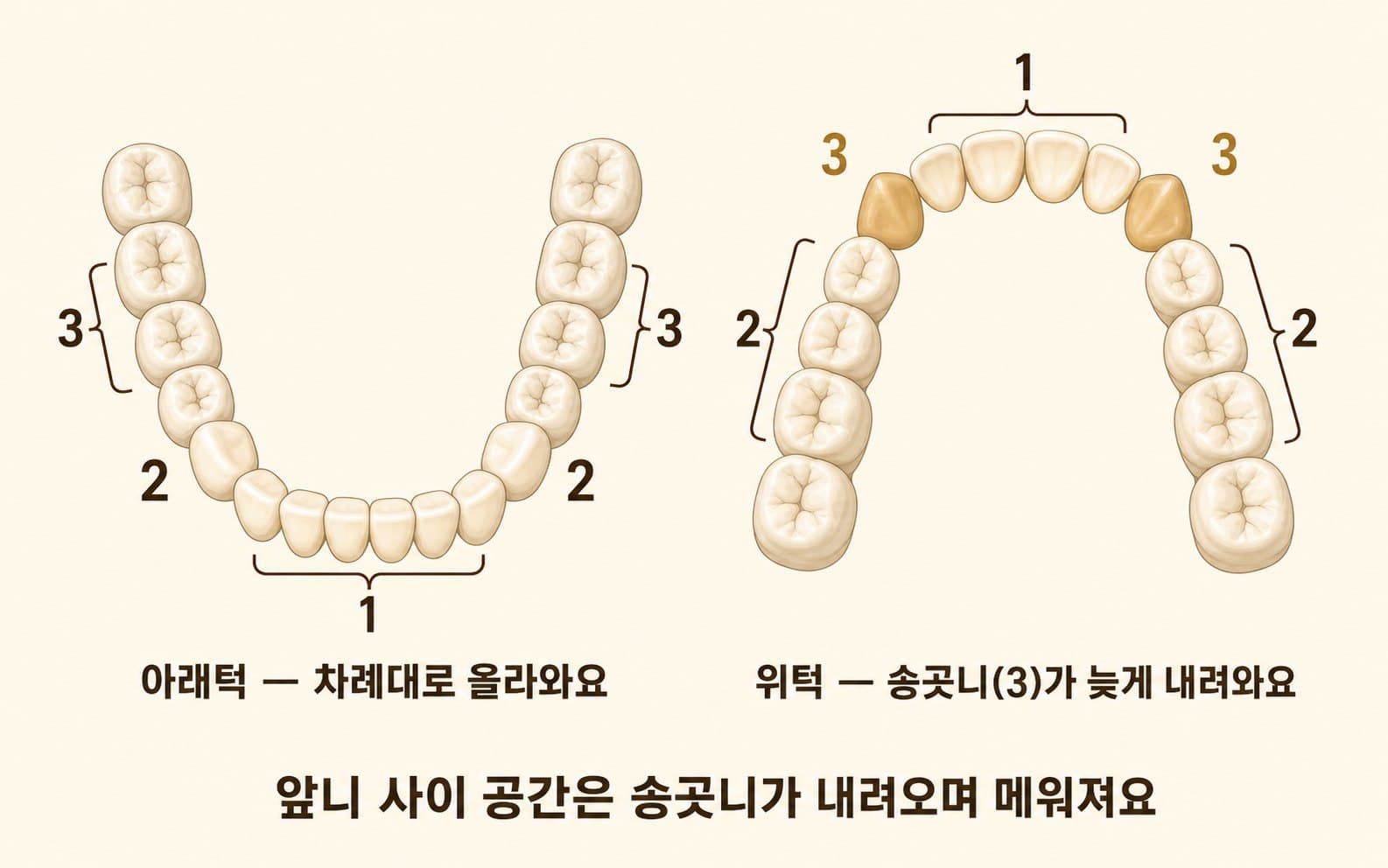 인포그래픽 — 영구치 맹출 순서 비교 — 아래(앞니→송곳니→작은어금니)와 위(앞니→작은어금니→송곳니), 위턱 송곳니가 늦게 나오는 지점 표시