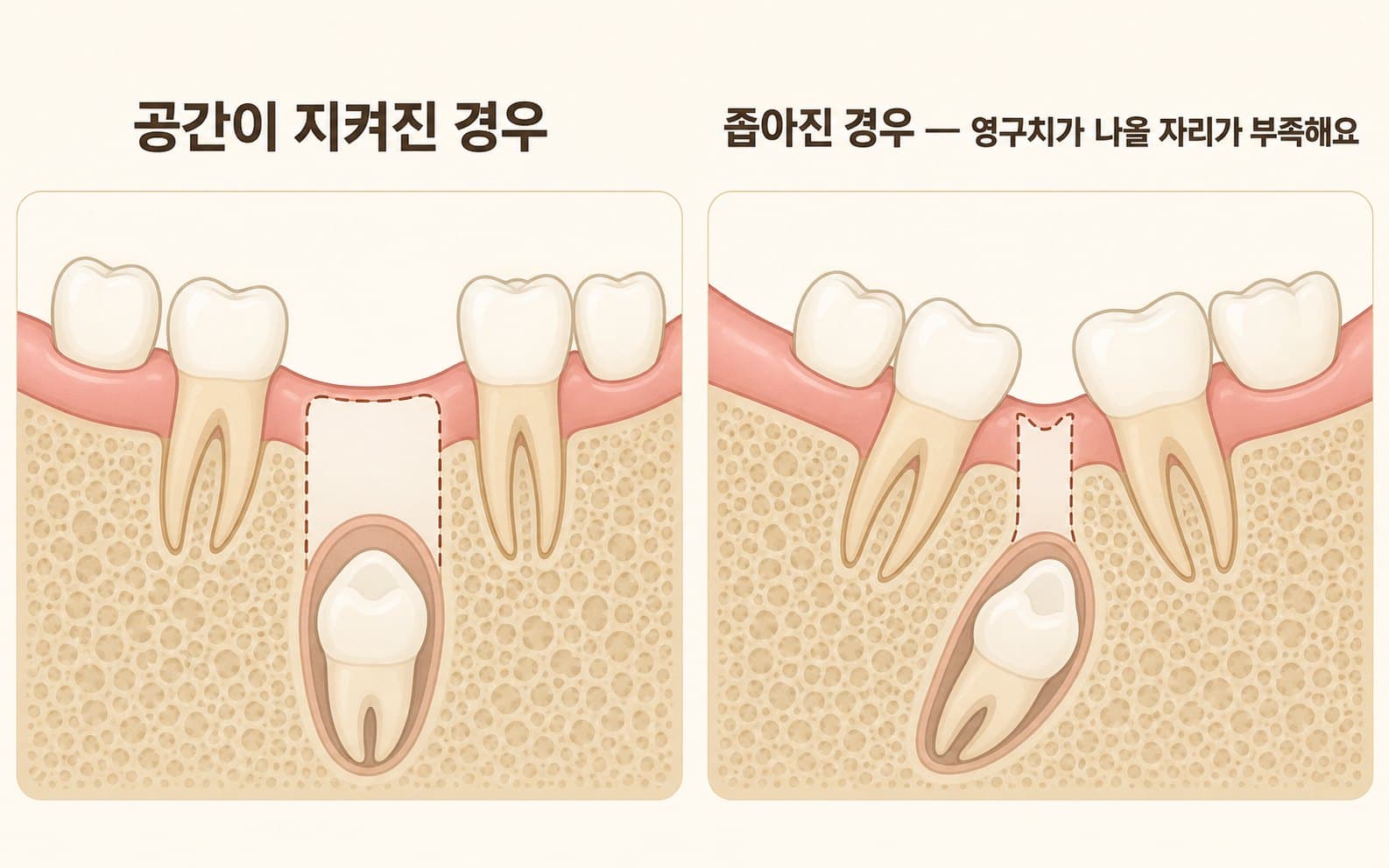 인포그래픽 — 유치 발치 후 공간 변화 — 정상적으로 공간이 유지된 경우와 방치되어 인접 치아가 기울어진 경우 비교