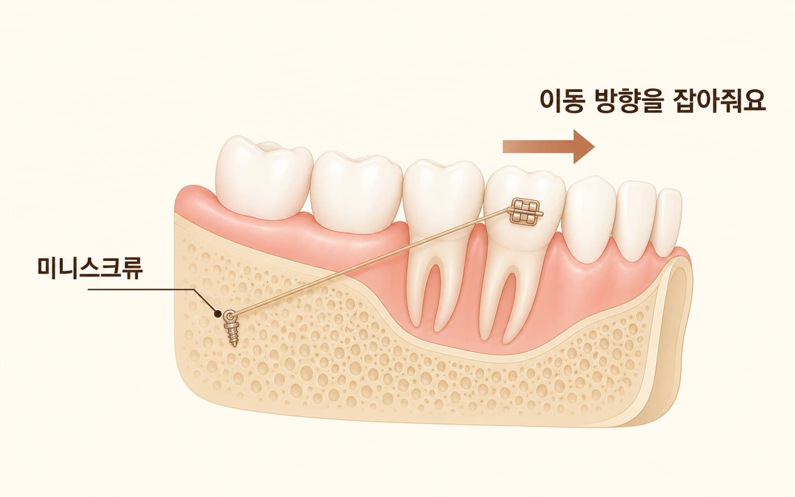 인포그래픽 — 미니스크류가 치아 이동 방향을 잡아주는 원리