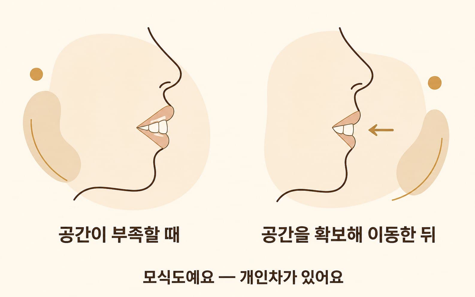 인포그래픽 — 발치 전후 옆모습 변화 예시
