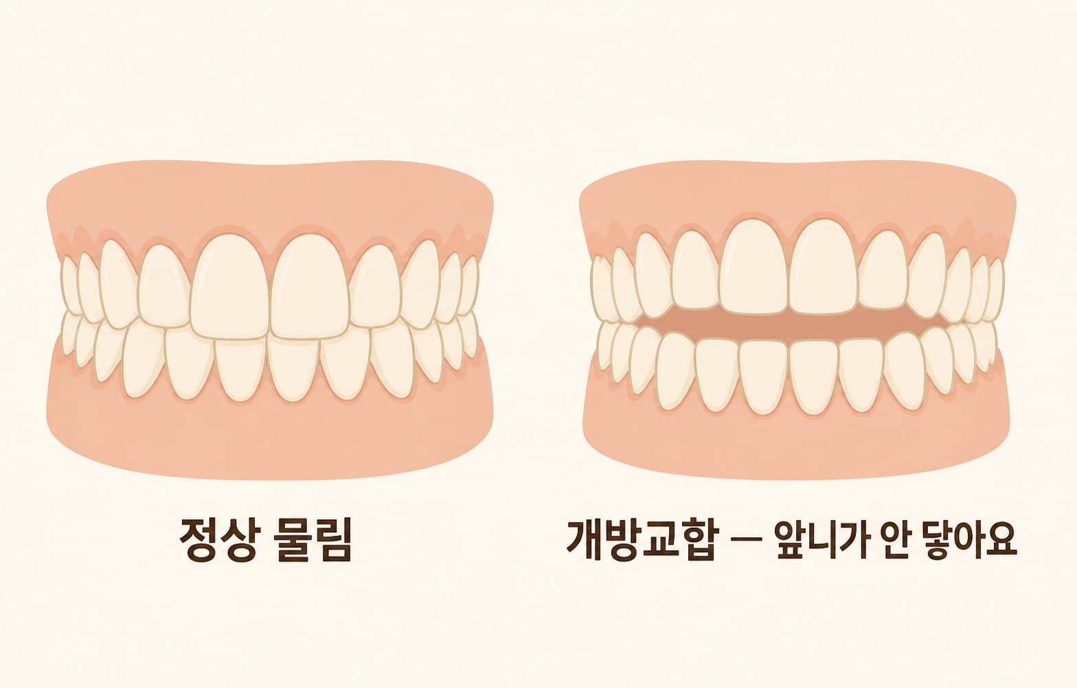 인포그래픽 — 정상 교합과 개방교합의 앞니 물림 차이