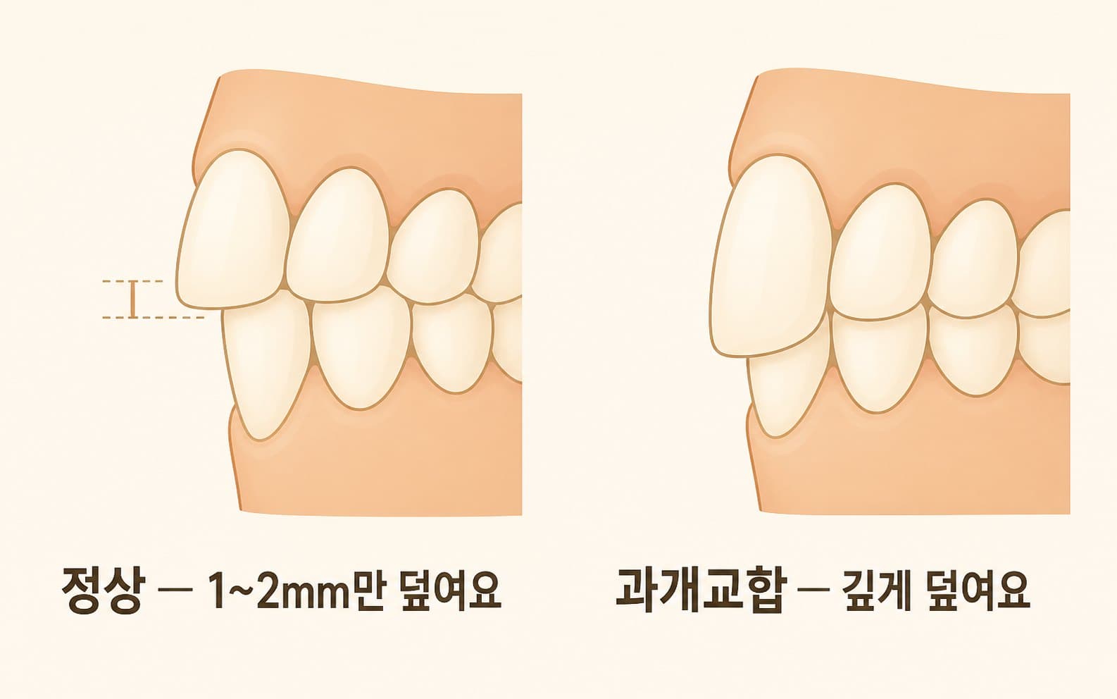 인포그래픽 — 정상 물림과 과개교합의 깊이 비교