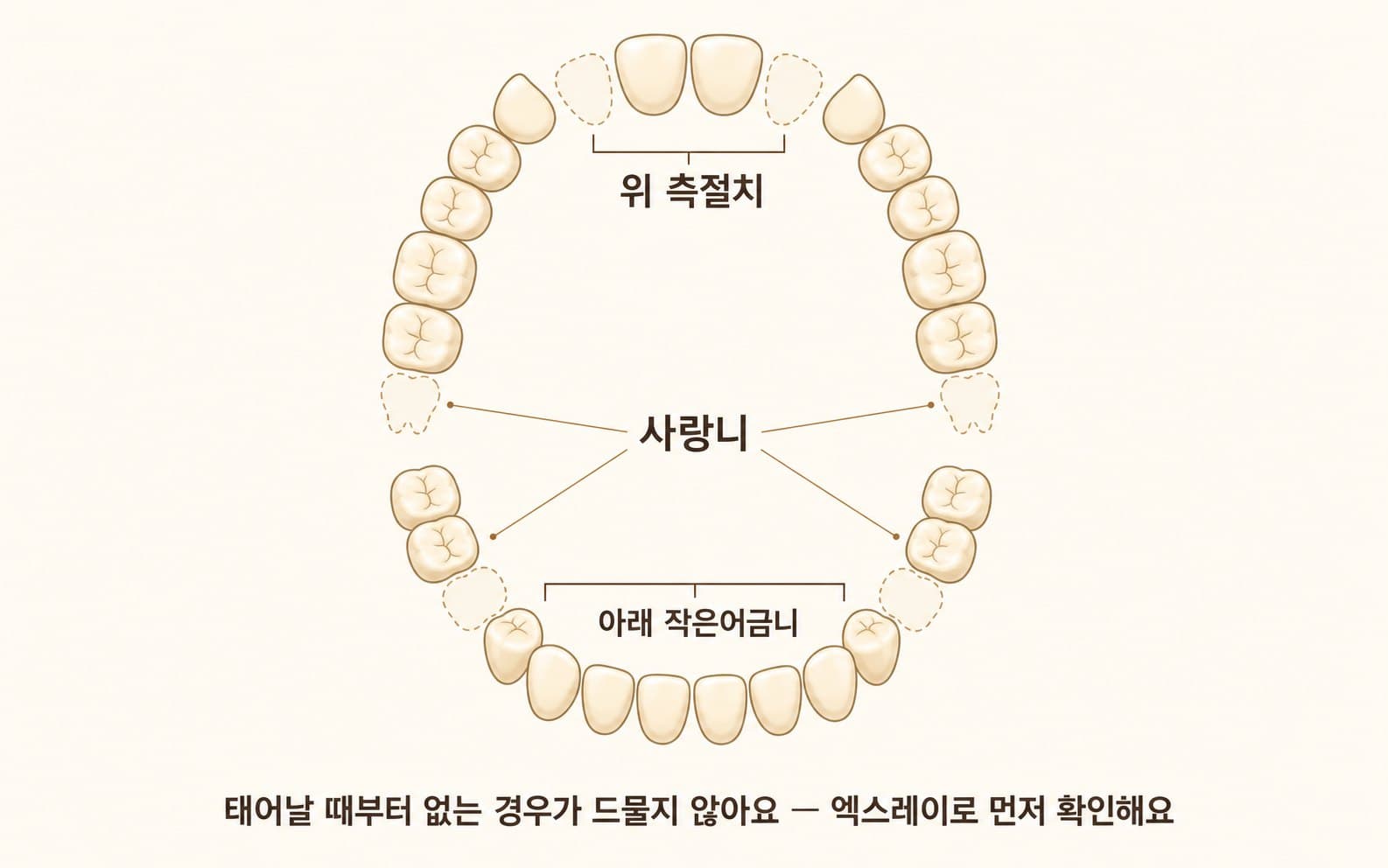 인포그래픽 — 결손치가 흔한 위치 — 측절치·아래 소구치·사랑니