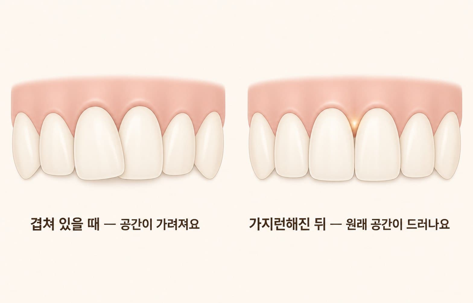 인포그래픽 — 치아가 겹쳐 있을 때와 펴진 뒤 잇몸 라인의 변화
