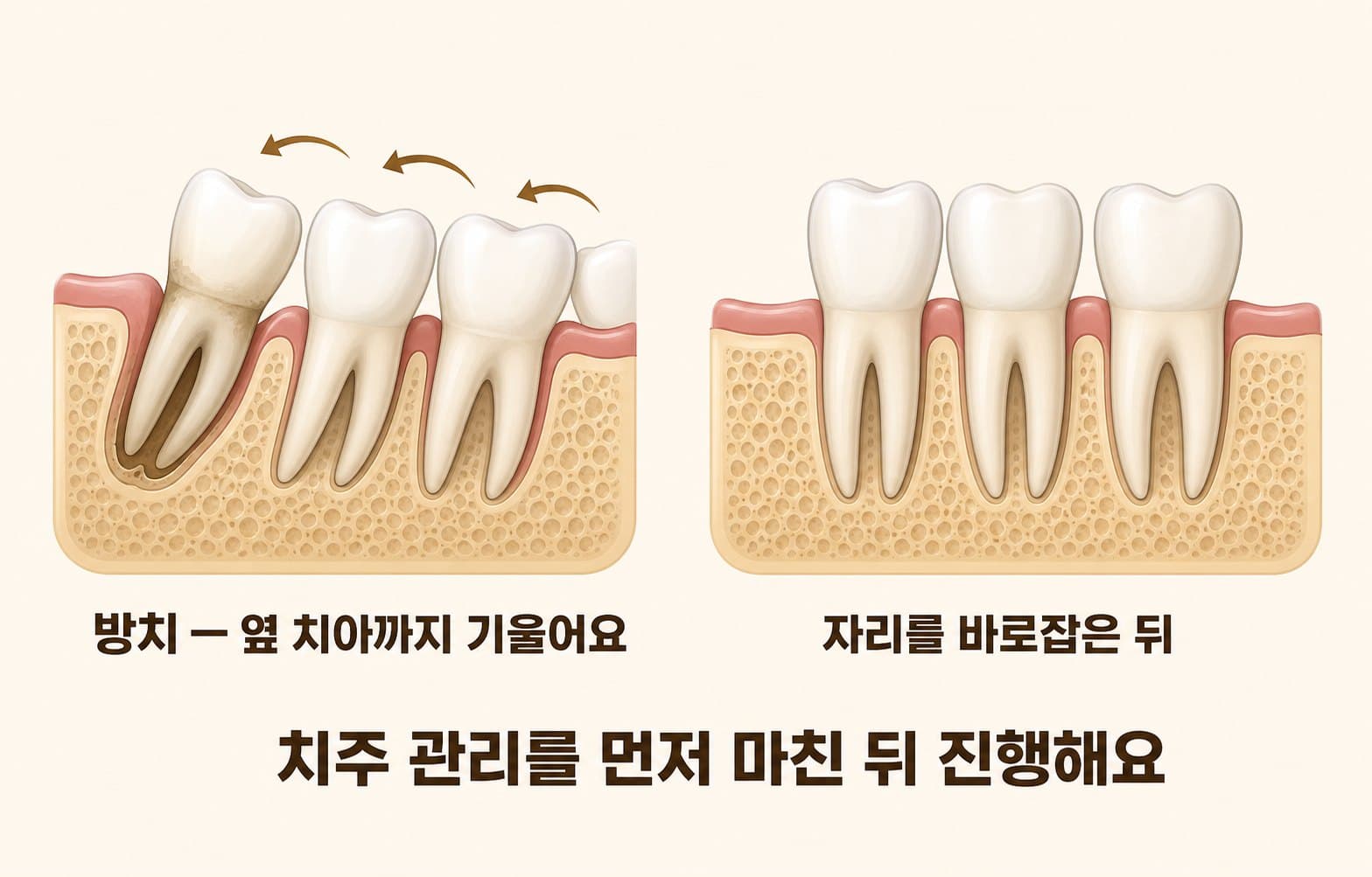 인포그래픽 — 흔들리는 치아 방치 vs 자리 바로잡기 — 옆 치아에 미치는 영향 비교