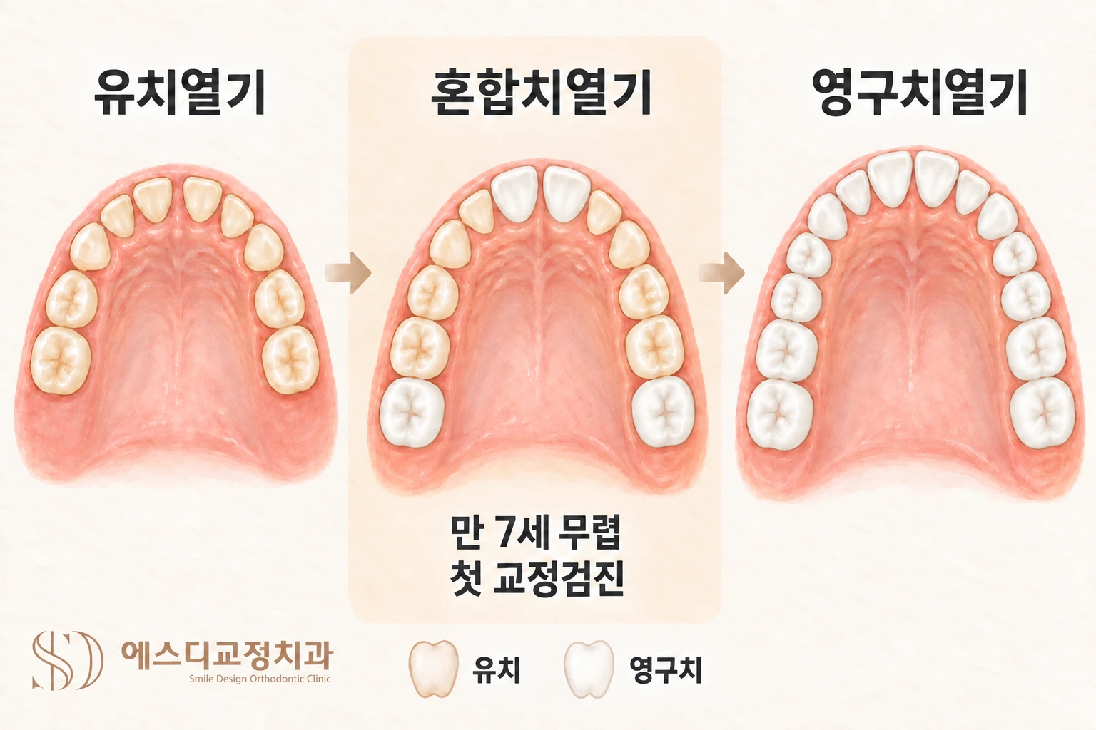 유치열기·혼합치열기·영구치열기의 위턱 치열을 비교한 삽화 — 유치는 연한 베이지색, 영구치는 밝은 흰색으로 구분