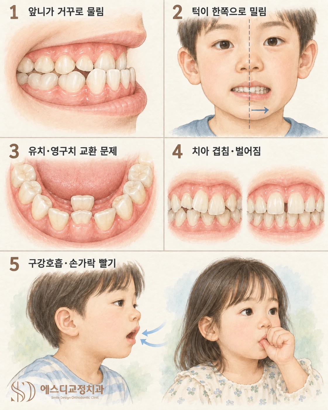 교정검진이 필요한 다섯 가지 신호를 그린 삽화 — 앞니 반대교합, 턱이 한쪽으로 밀림, 유치·영구치 교환 문제, 치아 겹침·벌어짐, 구강호흡·손가락 빨기