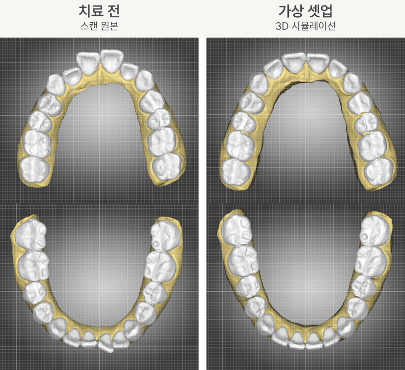 치료 전 치아 배열과 3D 시뮬레이션으로 계획한 치아 배열 비교