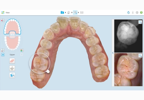 iTero의 3D 치아 모형과 같은 부위의 NIRI 영상 및 일반 컬러 영상 비교