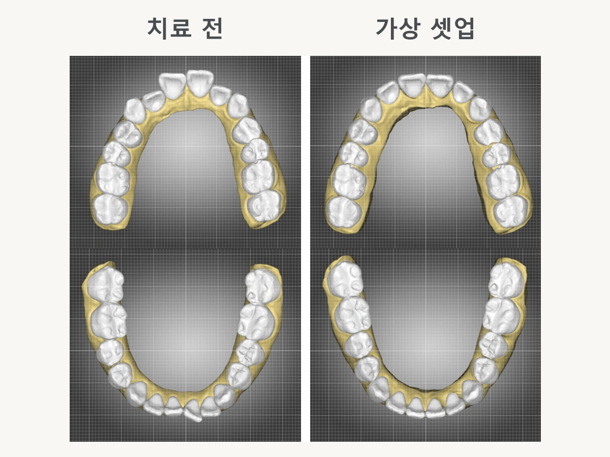 왼쪽 치료 전 구강 스캔과 오른쪽 가상 셋업의 치아 배열 비교. 가상 셋업은 실제 치료 결과가 아닌 3D 시뮬레이션입니다.
